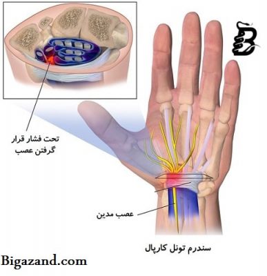 مچ بند برای تنگی کانال دست 